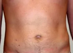 zsírleszívás
