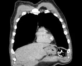 lymphoma