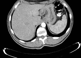 Helicobacter pylori