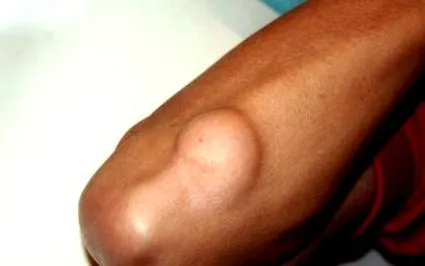 lipoma öröklődhet