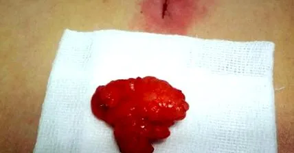 tumor