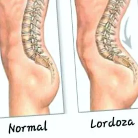 lordosis lordosis