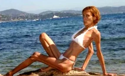 anorexia földi modelljei