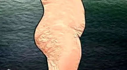 целулит целулит