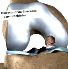 остеохондритис