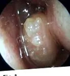 orr-papilloma