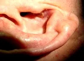squamoso orecchio