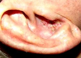 Enterobius vermicularis