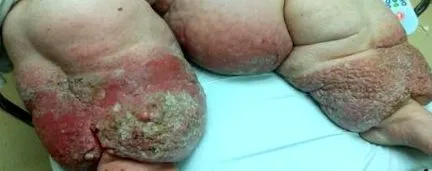 papillomatosis