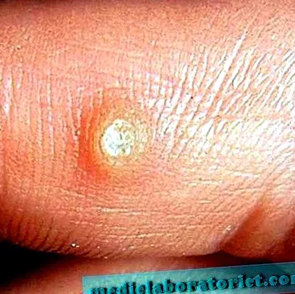 giardiasis