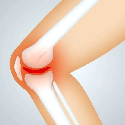 osteoarthritis