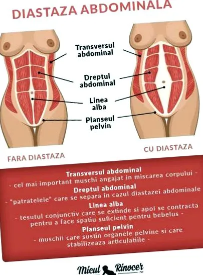 diasztázis