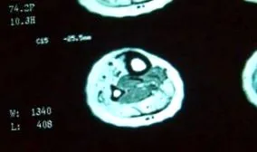 tooth charcot
