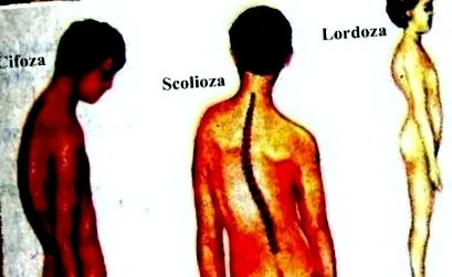 skolióza