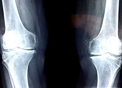 gyulladással degenerációt