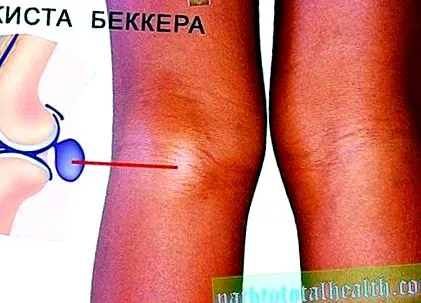 предписва артроза