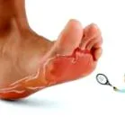 mycosis mycosis