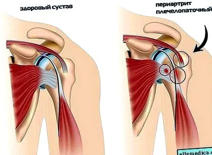 osteoarthritis