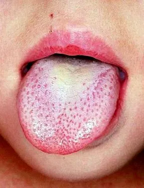 streptococcus