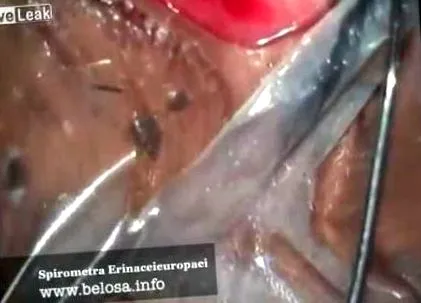 infúzió