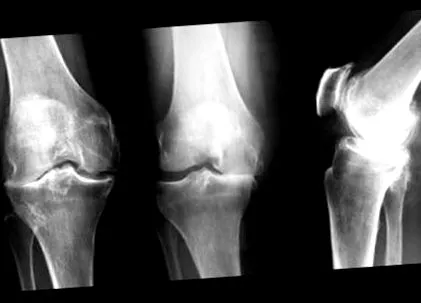 osteoarthritis kezelése