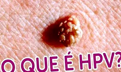 papilloma