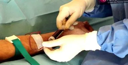 osteoarthritis