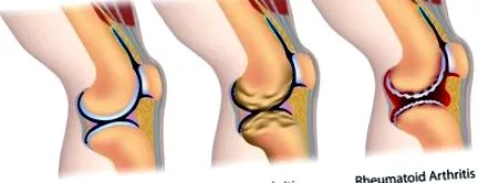 osteoarthritisében térd