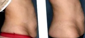 zónák