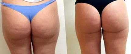 VelaShape III-