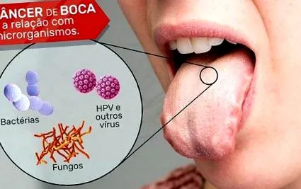 papilóm