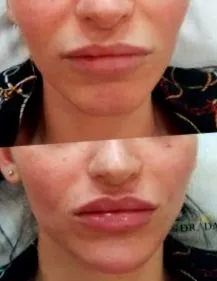 хијалуронска киселина младиот