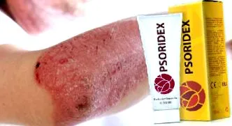vélemények psoridex