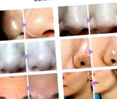 lipolaser kavitációs