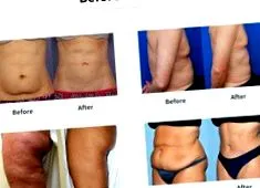 lipolaser vákuum