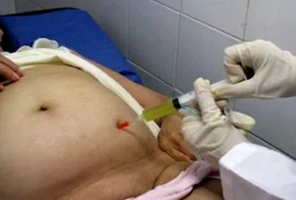 ascites folyadék