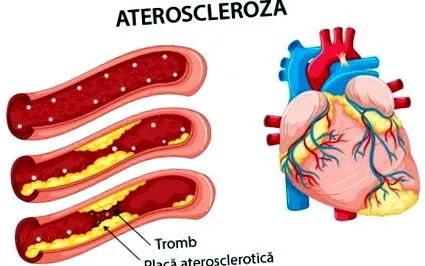 причини атеросклероза