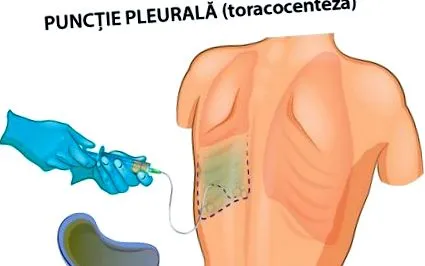 tüdőbiopszia