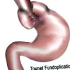 reflux betegség Gastroesophagealis reflux
