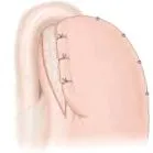 reflux betegség Gastroesophagealis reflux