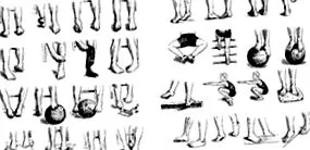 osteoarthritis