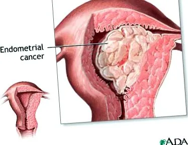 endometria