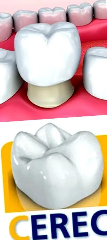 CEREC számítógépes fogkorona