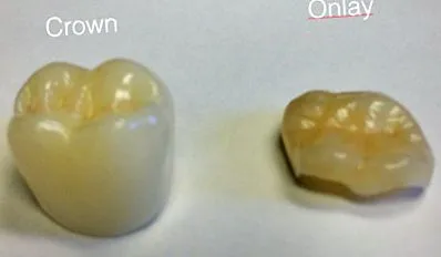 cirkónium CEREC számítógépes