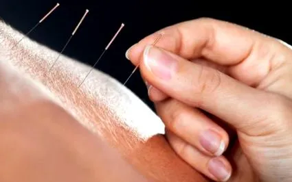 potrivi acupunctură