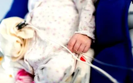 gastroschisis veleszületett