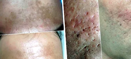 dermapen