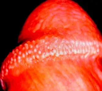 difhildobothriasis
