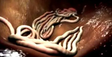 difhildobothriasis