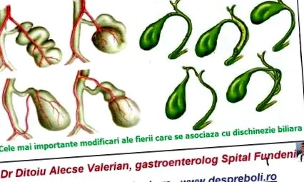 diszkinézia
